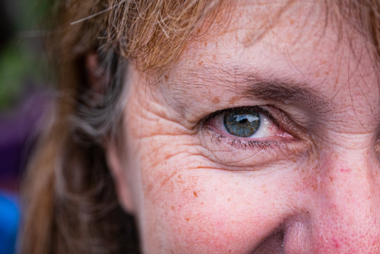 Get Rid of Wrinkles with Retinoids!