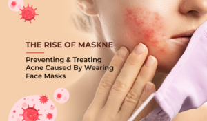 Maskne