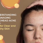 forehead acne