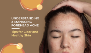 forehead acne