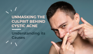 cystic acne treatment