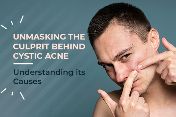 cystic acne treatment
