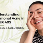 understanding hormonal acne