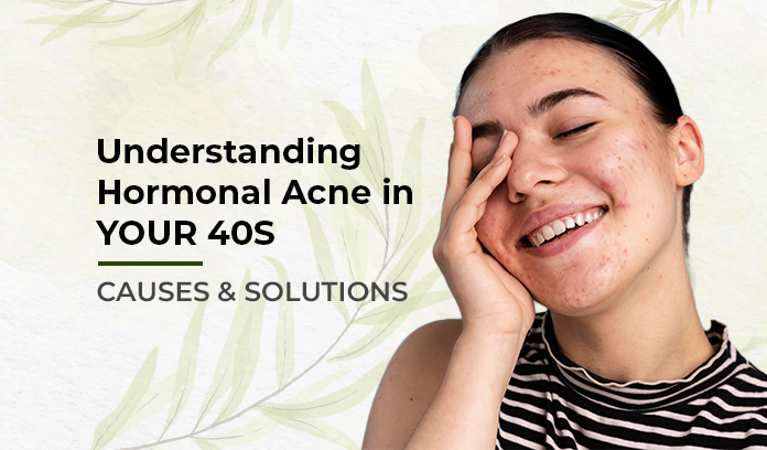understanding hormonal acne