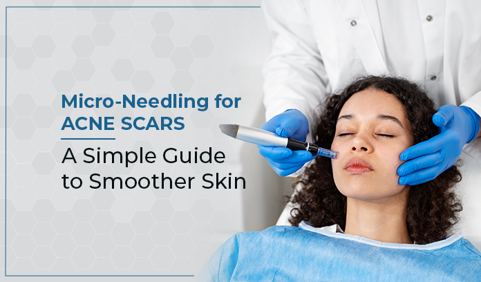 Micro-Needling for Acne Scars