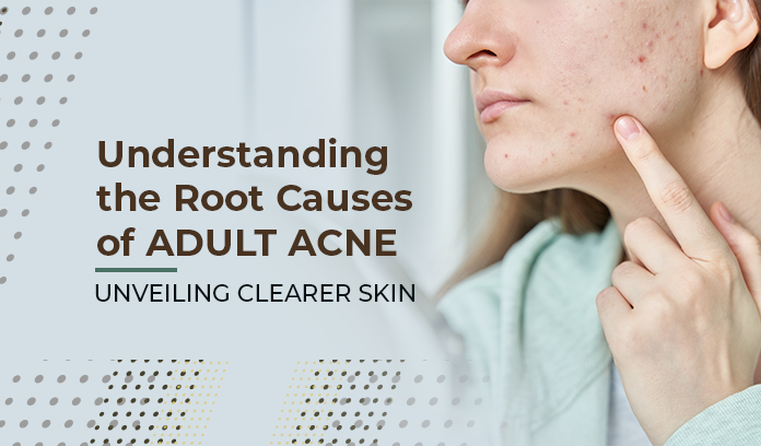 Root Causes of Adult Acne