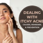 Dealing with Itchy Acne