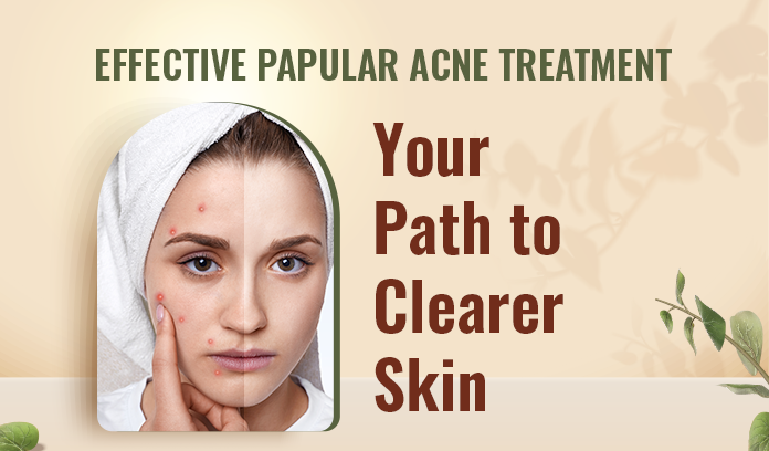 Papular Acne Treatment