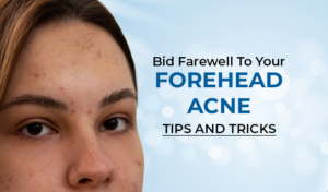Forehead Acne