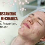 Understanding Acne Mechanica