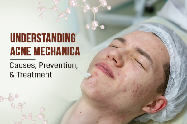 Understanding Acne Mechanica