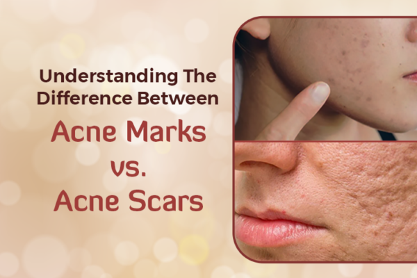 acne marks vs acne scars