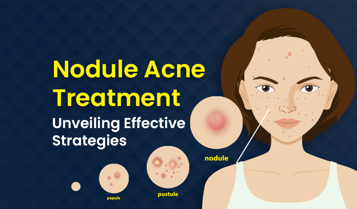 Nodule Acne Treatment