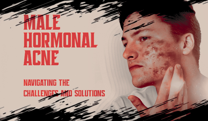Male Hormonal Acne