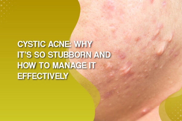 Cystic Acne: Why It’s So Stubborn and How to Manage It Effectively